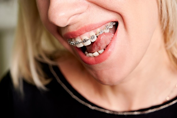 Ortodoncja - co to jest? | Baltic Ortho Clinic