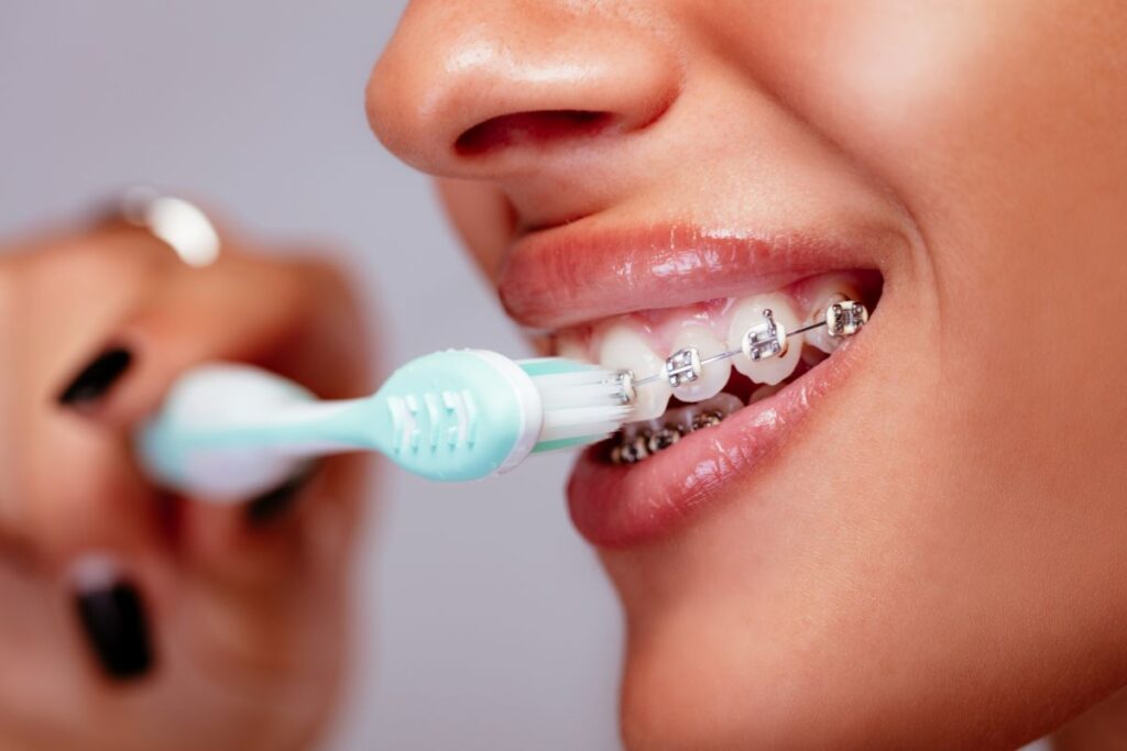 Jak myć zęby z aparatem? Praktyczny poradnik | Baltic Ortho Clinic