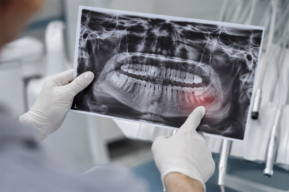 Torbiel zęba: objawy, diagnostyka, leczenie | Baltic Ortho Clinic